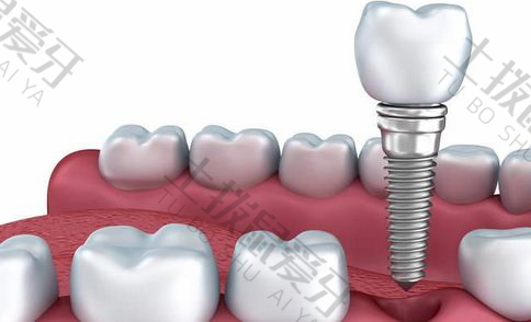 种植牙和真牙有什么区别