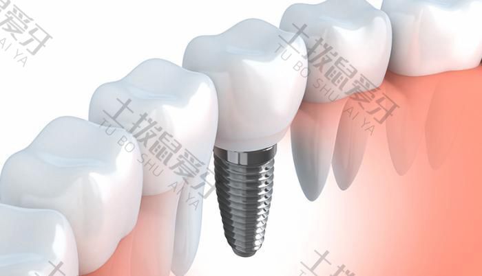 拔牙后能直接种植牙吗