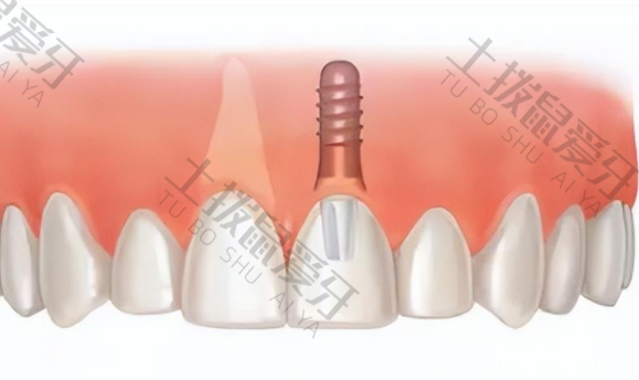 即刻种植牙步骤