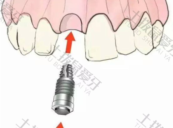 什么是即刻种植牙