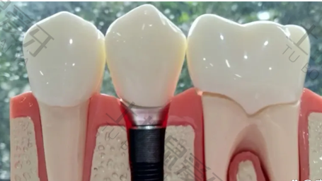 种植牙手术过程怎样操作