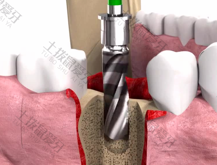 种植牙手术过程怎样操作