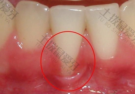 种植牙牙龈发炎怎么办