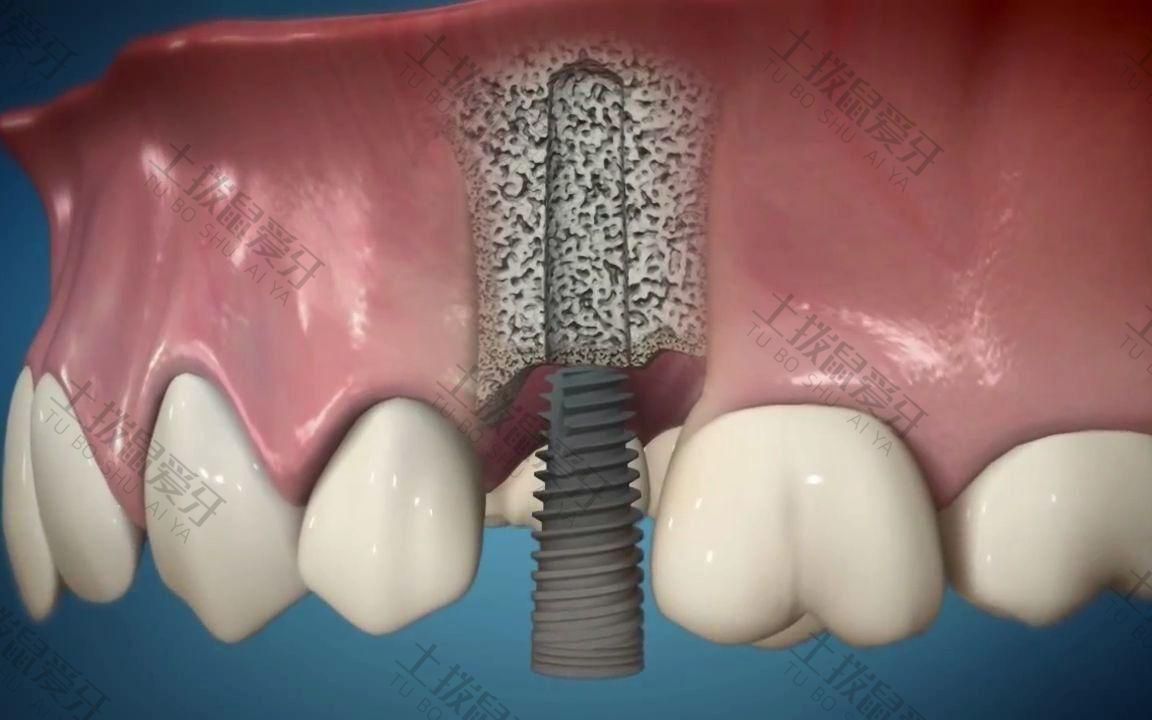 种植牙可以即拔即种吗
