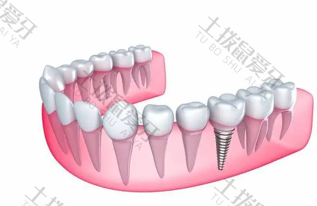 拔牙后2年后还能种植牙