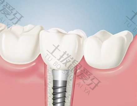 种植牙的种植体是什么材料