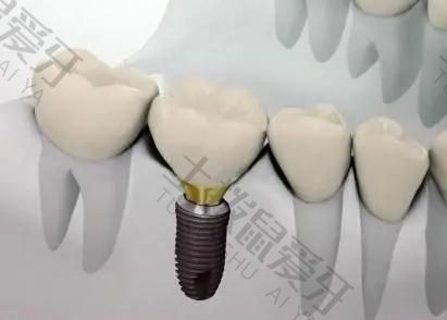 种植牙二期手术过程