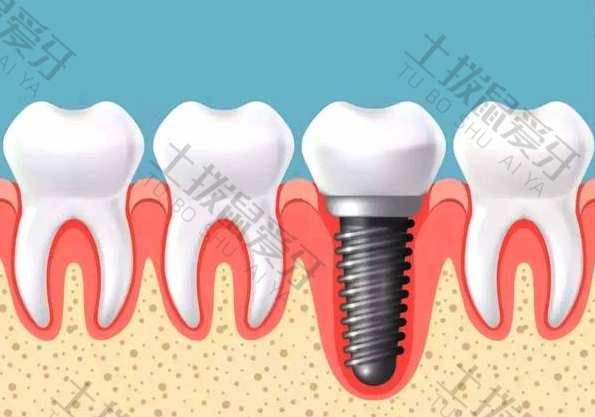 门牙种植牙牢固吗