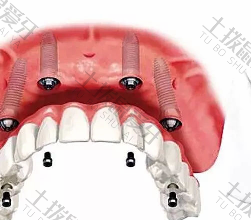 门牙种植牙全过程