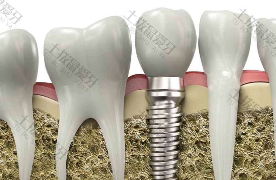 牙槽骨萎缩种植牙有用吗