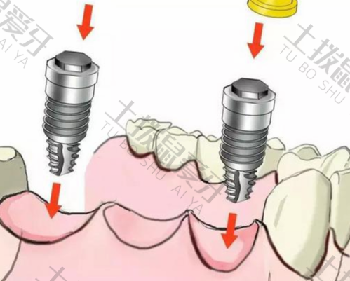 门牙种植缺牙期怎么办