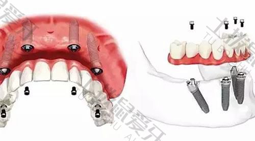 义齿和种植牙的区别