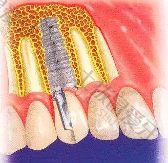种植牙手术后多久可以拆线