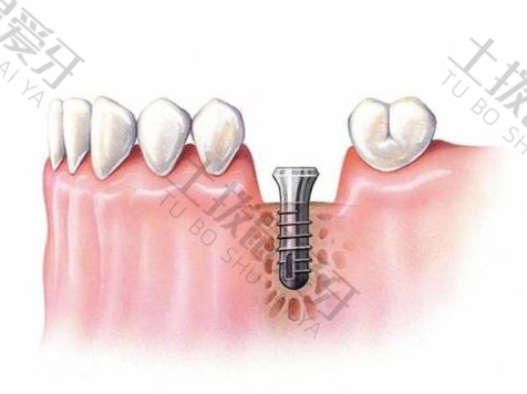 种植牙二期手术要多久
