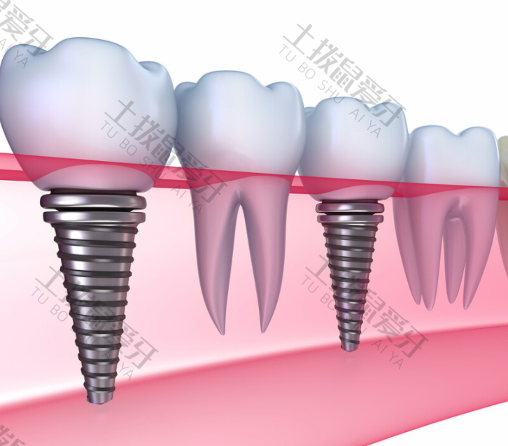 满口牙种植一般多少钱