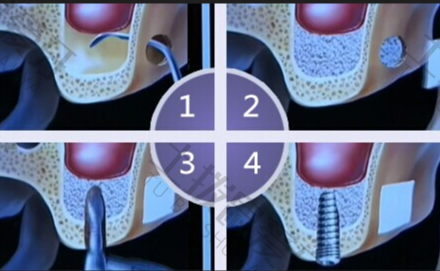 即刻种植牙的利与弊