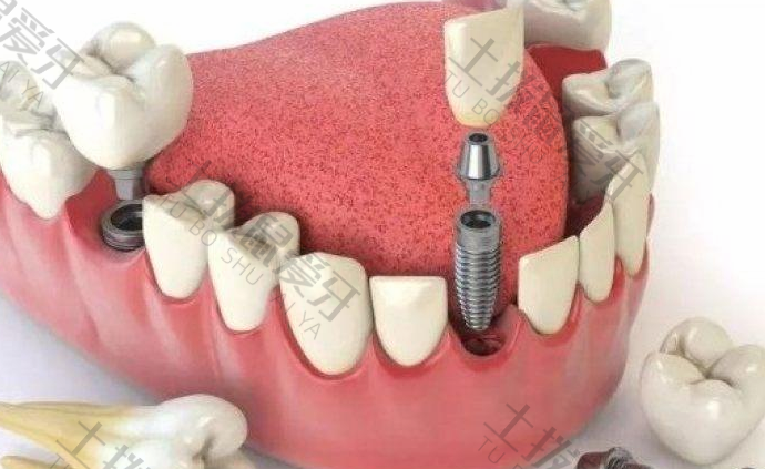 种植牙手术的过程