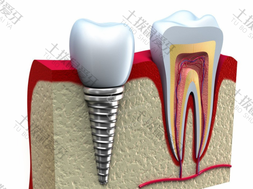 门牙种植牙过程中的影响上班