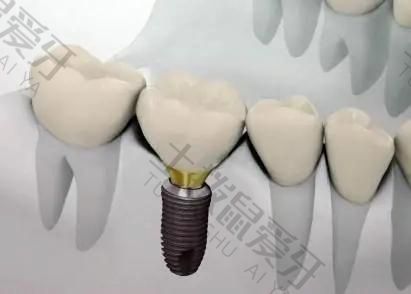 种植牙价格是多少