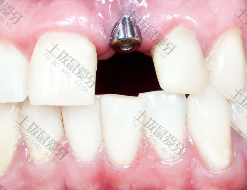 种植牙最严重的副作用