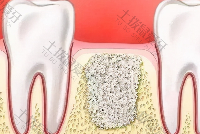 种牙填骨粉后遗症