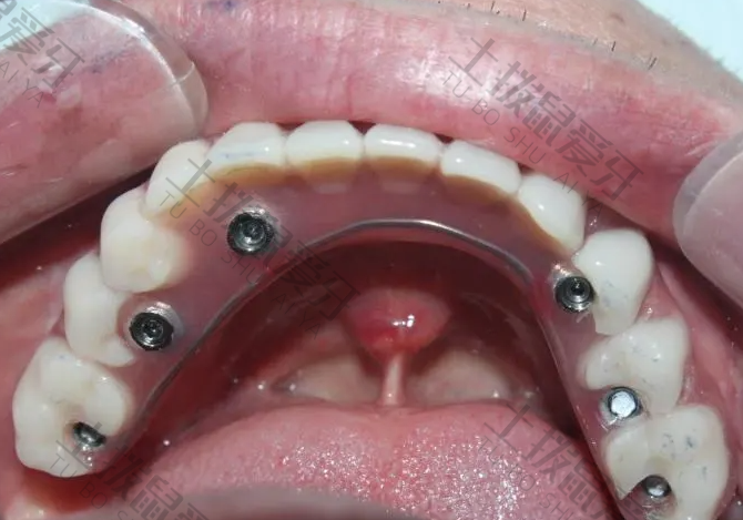 半口牙缺失最好的治疗方案