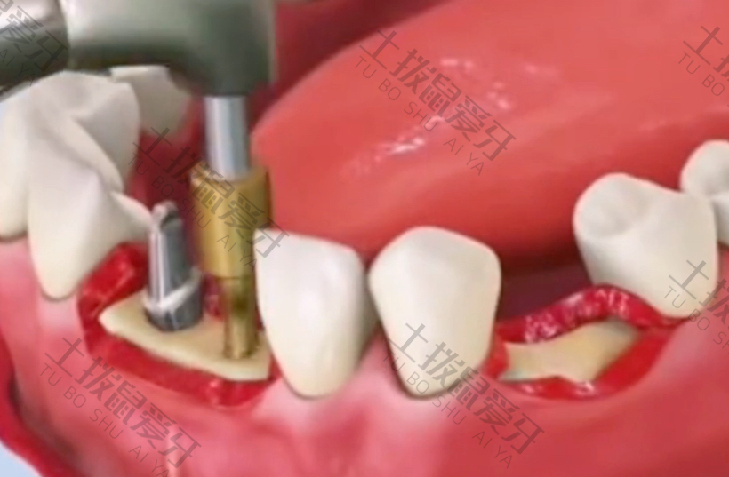 种植牙临时牙冠制作步骤