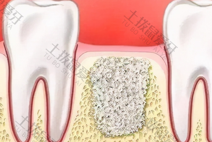 牙齿拔除后多久可以做种植牙