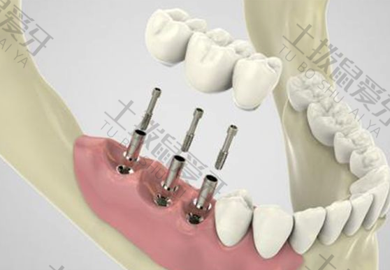 种植牙基台是什么材料