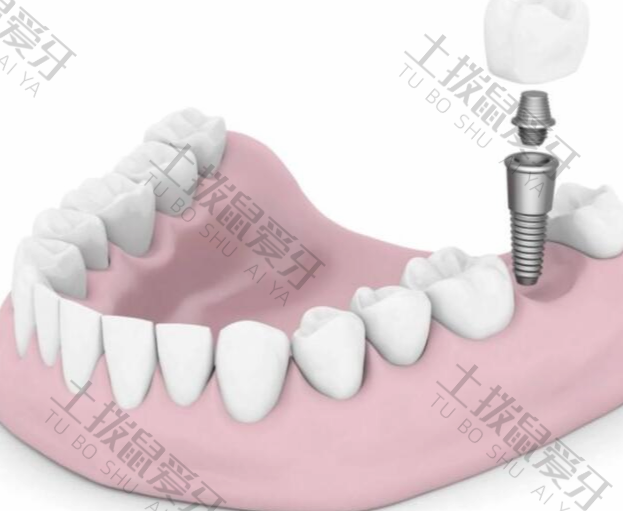 种植牙手术的基本流程