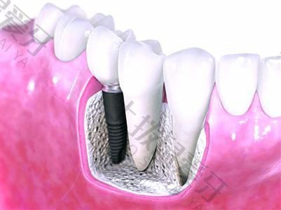 种植牙手术的基本流程