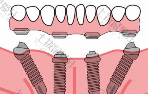 种植牙二期手术怎么做
