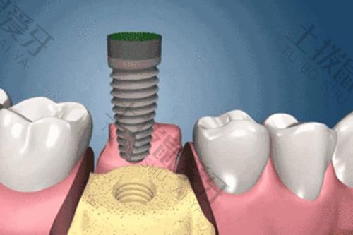种植牙二期手术怎么做