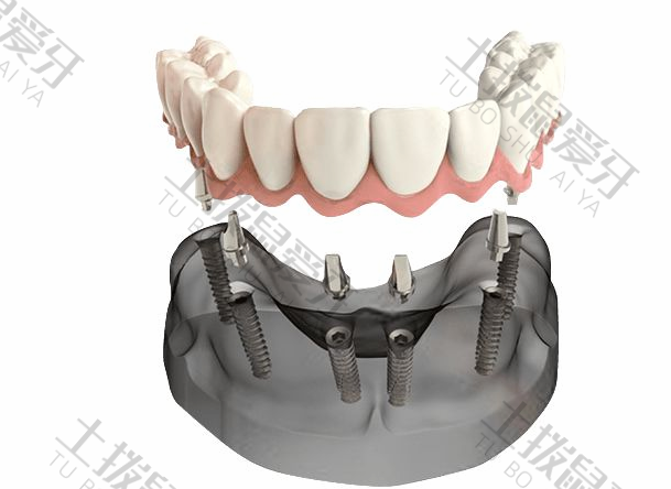 种植牙基台和牙冠怎么固定