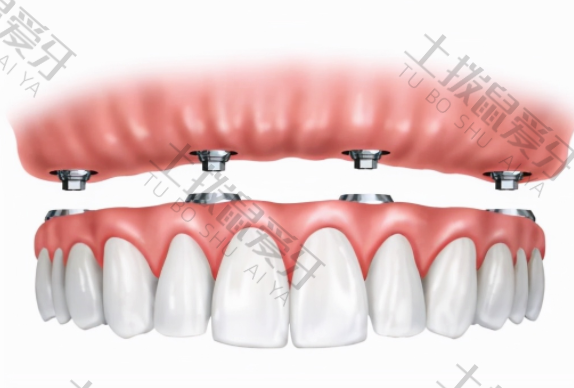 全口种植牙需种几颗