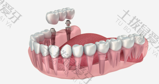 全口种植牙有几种方式