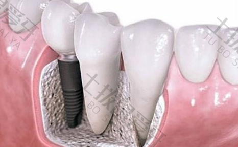 全口牙种植手术修复全过程