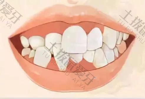 牙齿稀疏矫正需要拔牙吗