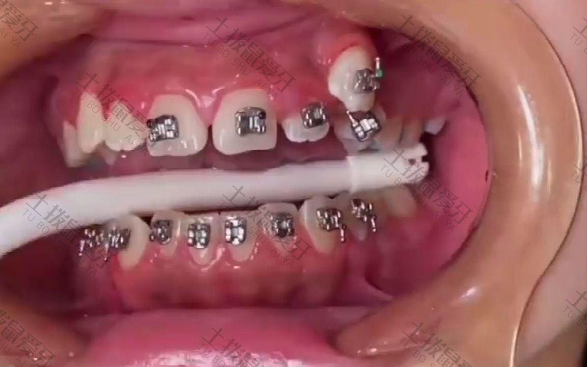 牙齿深覆合矫正过程