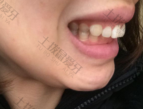 儿童牙齿深覆合需要矫正吗