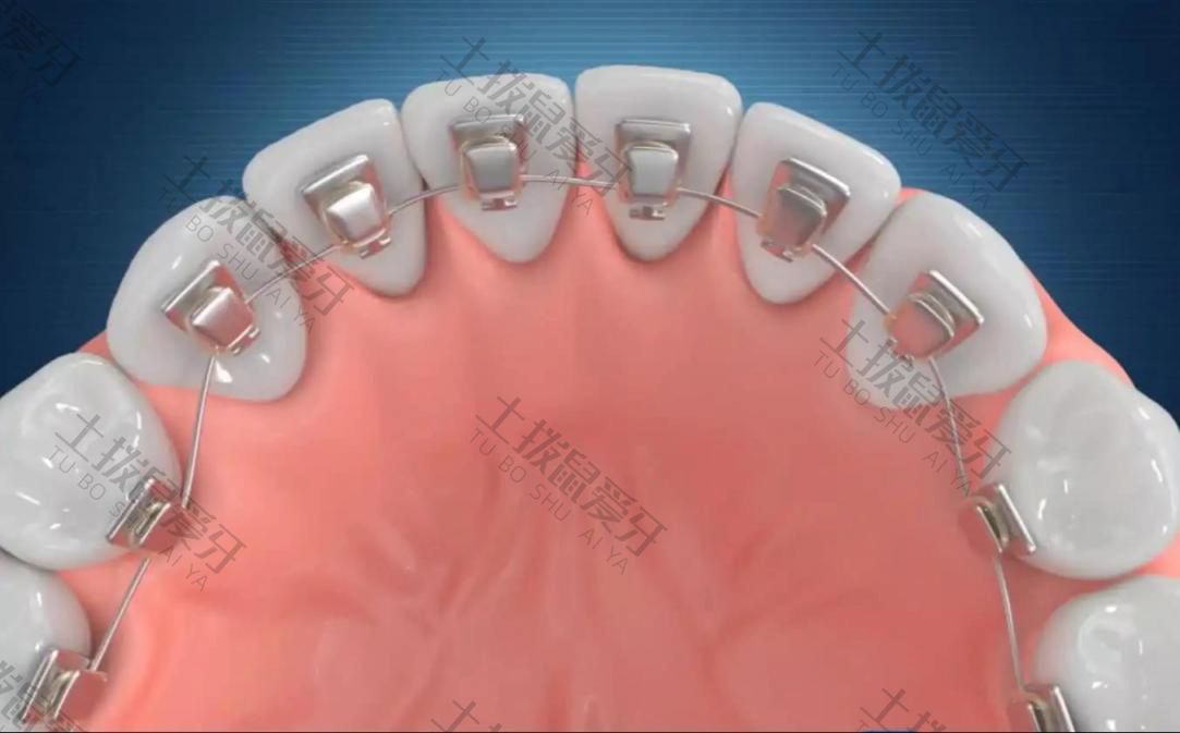 地包天牙齿矫正器要戴多长时间
