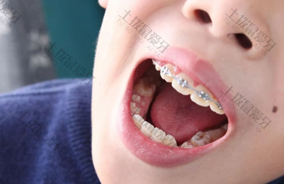 儿童牙齿深覆合矫正后会反弹吗