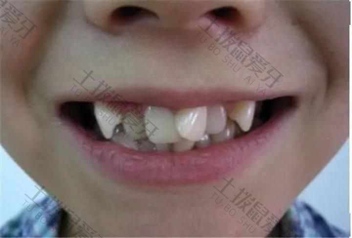 牙齿参差不齐能矫正吗 