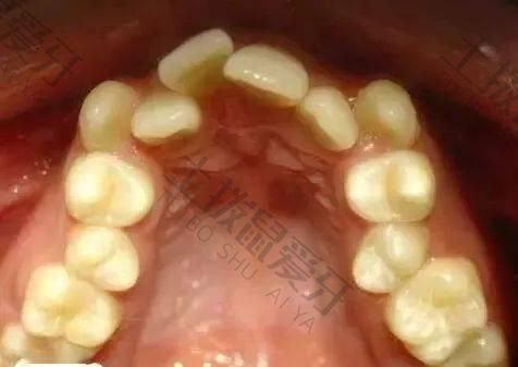牙齿拥挤不拔牙矫正会凸出来吗