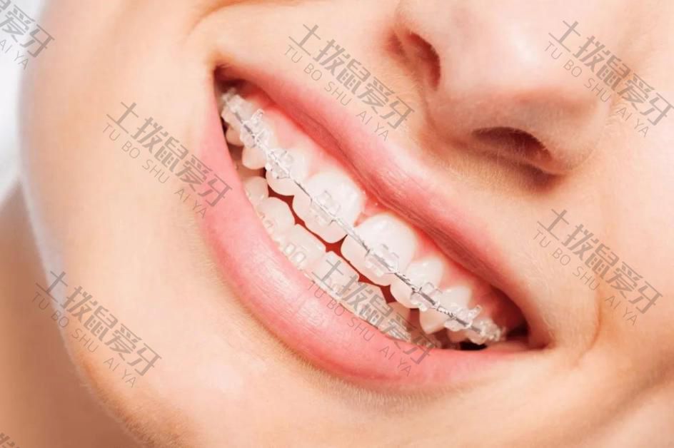 牙齿稀疏牙缝大怎么矫正效果最好