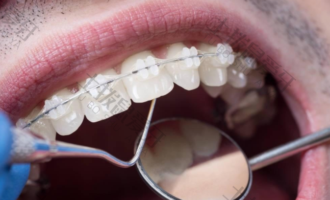 早期牙齿矫正材料有哪些