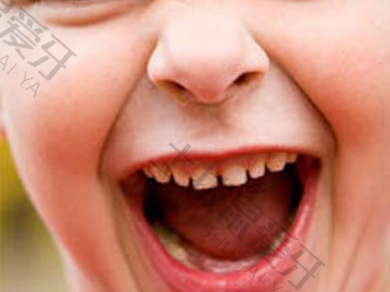 儿童早期矫正牙齿会不会反弹