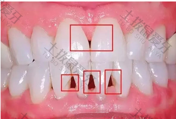牙齿黑三角可以修复吗