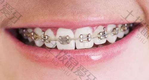 牙齿稀疏牙缝大可以只矫正上牙吗