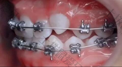 牙齿早期矫正干预怎么做